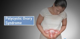 What is Polycystic Ovary Syndrome (PCOS)? Know Causes, Complications, Home Care and Treatments Polycystic Ovary Syndrome