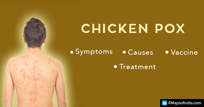 Chickenpox: Symptoms, Causes, Vaccine and Treatment