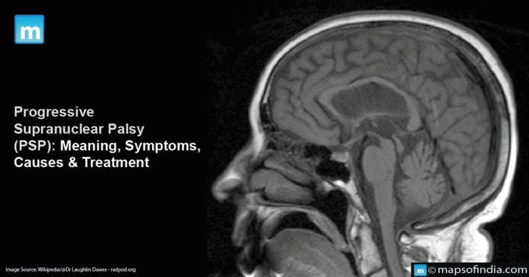Progressive Supranuclear Palsy: Meaning, Symptoms, Causes & Treatment Progressive Supranuclear Palsy: Meaning, Symptoms, Causes & Treatment